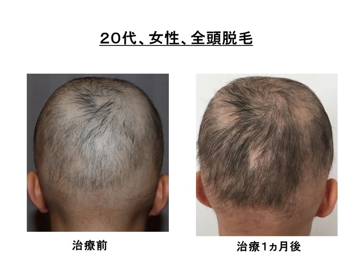 円形脱毛症　病院